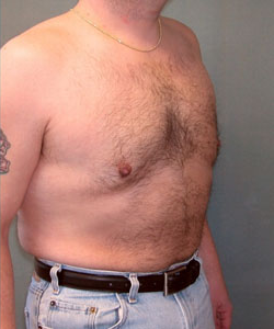 Severe Gynecomastia