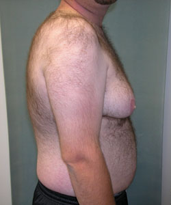 Severe Gynecomastia