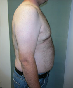 Severe Gynecomastia