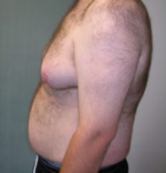 Severe Gynecomastia