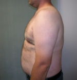 Severe Gynecomastia