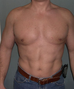 Severe Gynecomastia