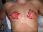 Severe Gynecomastia