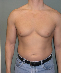 Severe Gynecomastia