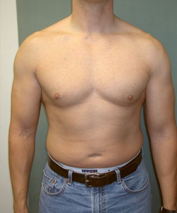 Severe Gynecomastia