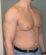 Severe Gynecomastia