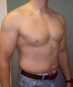 Severe Gynecomastia