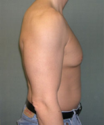 Severe Gynecomastia