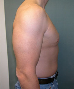 Severe Gynecomastia