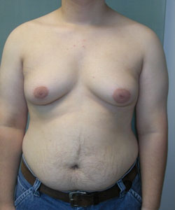 Severe Gynecomastia