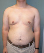 Severe Gynecomastia