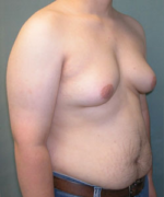 Severe Gynecomastia