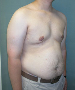 Severe Gynecomastia