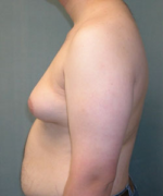 Severe Gynecomastia