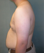 Severe Gynecomastia