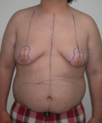 Severe Gynecomastia