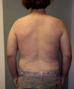 Severe Gynecomastia