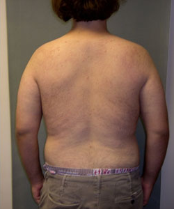 Severe Gynecomastia