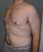 Severe Gynecomastia