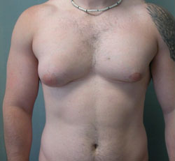 Severe Gynecomastia Before Photo Severe Gynecomastia