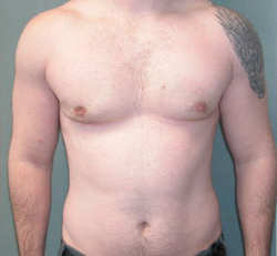 Severe Gynecomastia