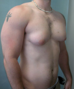 Severe Gynecomastia