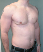 Severe Gynecomastia