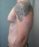 Severe Gynecomastia