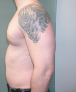 Severe Gynecomastia