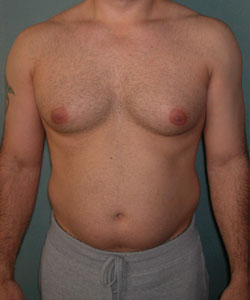 Severe Gynecomastia