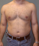 Severe Gynecomastia