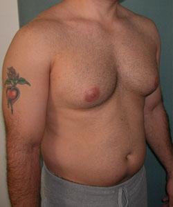 Severe Gynecomastia