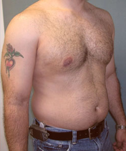 Severe Gynecomastia