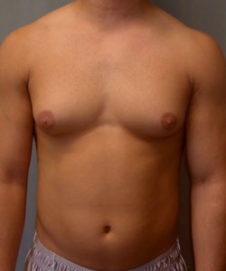 Severe Gynecomastia Before Photo Severe Gynecomastia