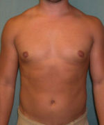 Severe Gynecomastia