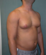 Severe Gynecomastia