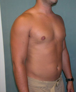 Severe Gynecomastia