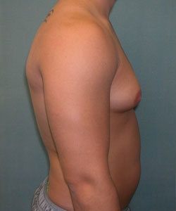 Severe Gynecomastia