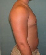 Severe Gynecomastia