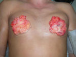 Severe Gynecomastia