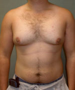 Severe Gynecomastia