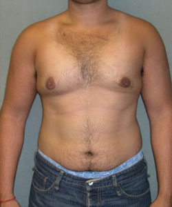 Severe Gynecomastia