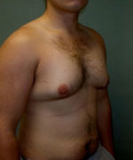 Severe Gynecomastia