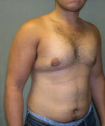 Severe Gynecomastia