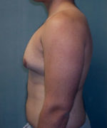 Severe Gynecomastia