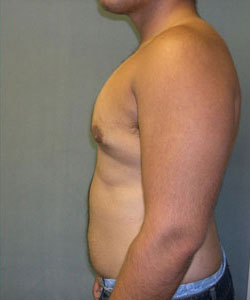 Severe Gynecomastia