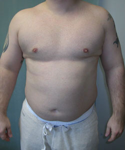 Severe Gynecomastia Before Photo Severe Gynecomastia