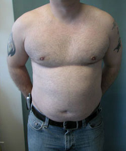 Severe Gynecomastia