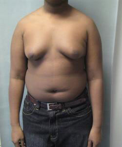 Severe Gynecomastia