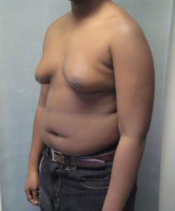 Severe Gynecomastia